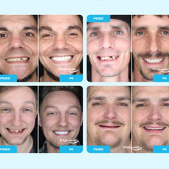 SMILEFIT PRO – NASTAVITEĽNÁ SADA ZUBNÝCH PROTÉZ PRE DOKONALÝ ÚSMEV